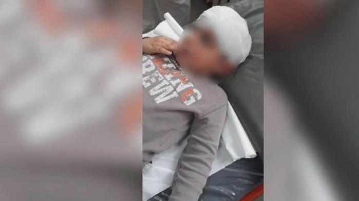 Момченцето е с наранявания по лицето Куче нападна 5-годишно дете