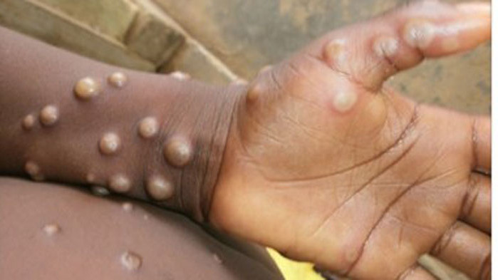 Носители на предполагаемия вирус са били засечени в аптека в