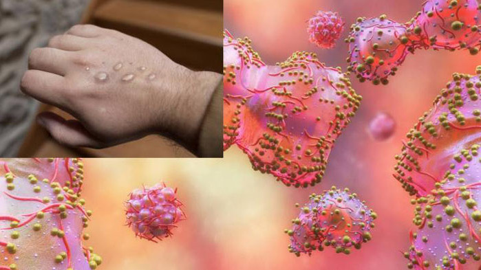 Още два нови случая на маймунска шарка бяха потвърдени в