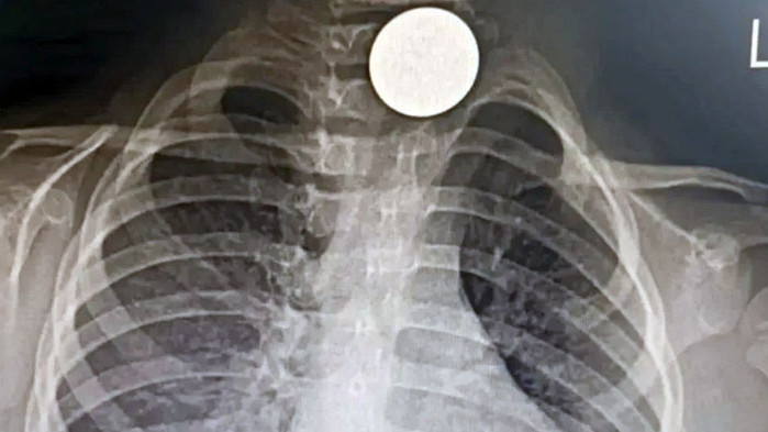 Лекарите останаха изненадани, а случаят ще бъде описан в научна