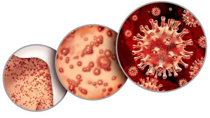 Администрацията на американския президент Джо Байдън обяви маймунската шарка за