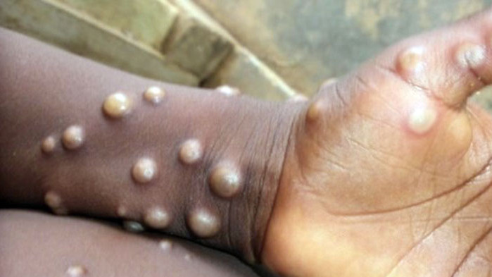 За една седмица случаите на маймунска шарка в световен мащаб