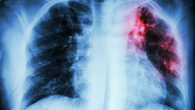 Броят на хората заразени с туберкулоза включително резистентната към лекарства