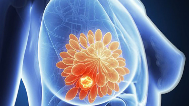Китайски учени откриха нова терапевтична цел за тройния отрицателен рак на гърдата
