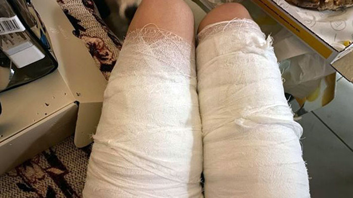 Чака ме лечение поне 3 месеца, има риск белезите да