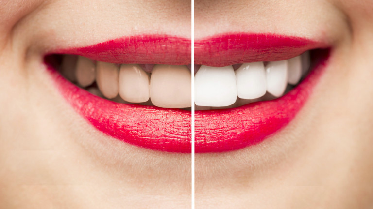 Блестящите бели зъби отдавна са се наложили като стандарт за красота. И