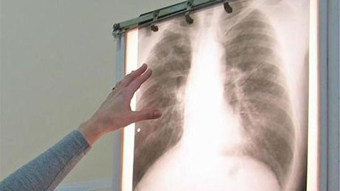12 области са с тревожно високи нива на заболели от туберкулоза