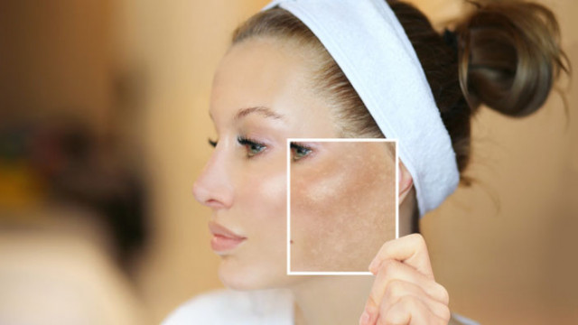 Акнето е кожен проблем който не засяга само тийнейджъри а