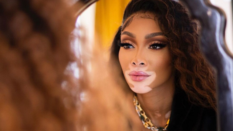 Уини Харлоу e първият модел в света с витилиго и