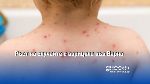 Увеличават се случаите на варицела във Варна и областта сочат