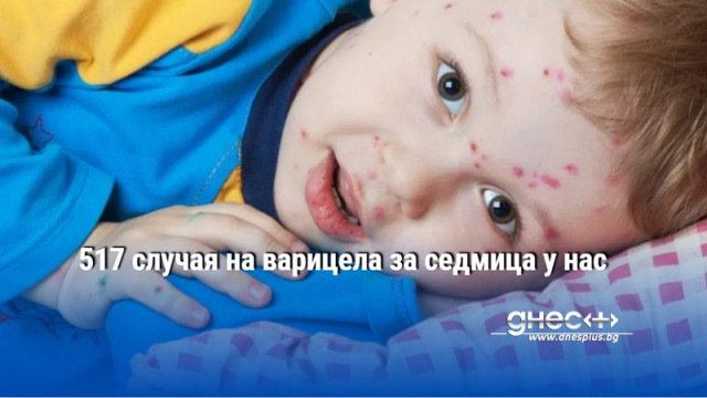 517 случая на варицела за седмица у нас