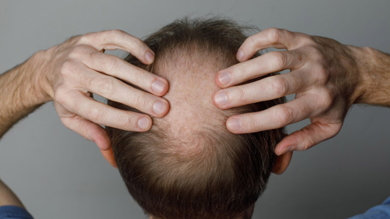 Оплешивяването - драма, част от живота или... бизнес за милиарди