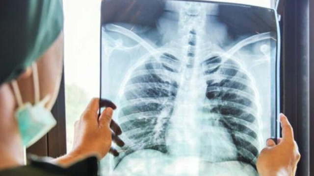 Предвиждат над 4 млн евро за превенция на туберкулозата у