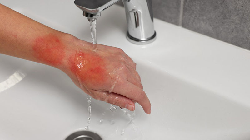 Какво да правим при изгаряне