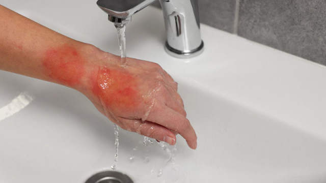 Какво да правим при изгаряне