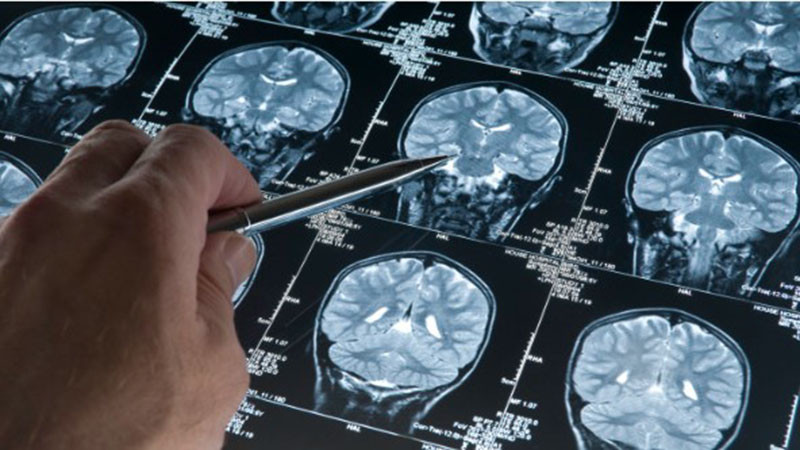 Ключов препарат за изследване за Паркинсон и деменция липсва в болниците у нас