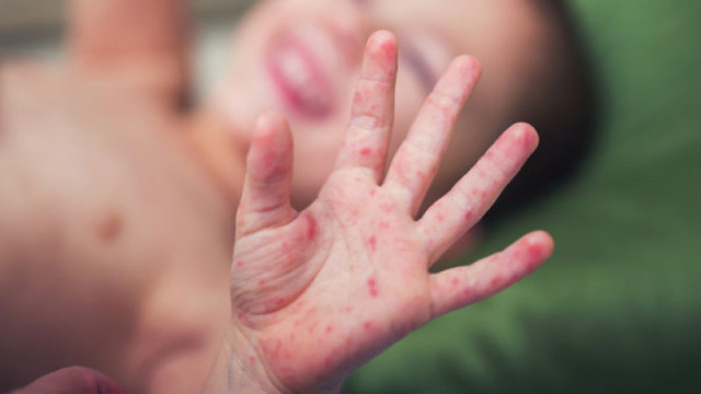 99 са вече заразените с морбили в страната