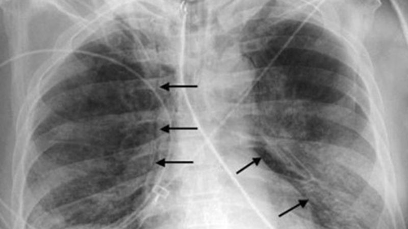 Първи случай на ку-треска в Пловдив