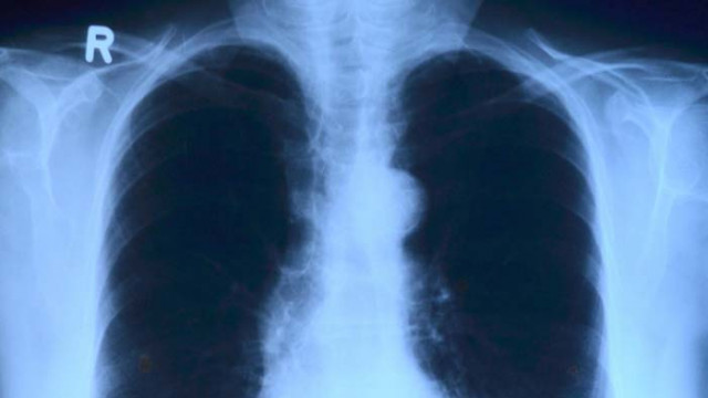 Проф. Галина Кирова: Пълното възстановяване на белия дроб след Ковид е след третия месец