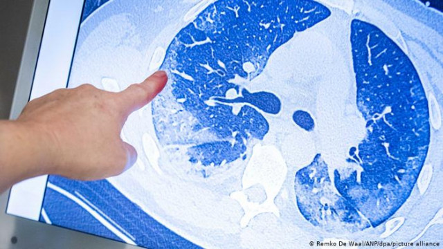 102-ма са излекуваните от COVID-19 във Варна за денонощието, намаляват  и приетите в болница