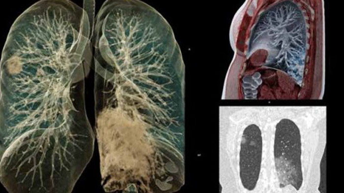 Какви поражения нанася COVID на белите дробове