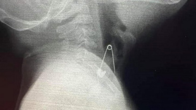 Екип специалисти от УМБАЛ „Св. Марина“ – Варна успешно оперираха бебето, глътнало безопасна игла